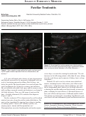 Cover page: Patellar Tendonitis