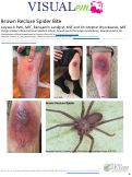 Cover page: Brown Recluse Spider Bite