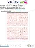 Cover page: Acute Pericarditis: Electrocardiogram