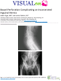 Cover page: Bowel Perforation Complicating an Incarcerated Inguinal Hernia