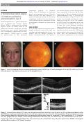 Cover page: A microstructural retinal analysis of membrano-proliferative glomerulonephritis type II