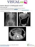 Cover page: Gastric Bezoar on Radiograph and CT