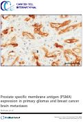 Cover page: Prostate specific membrane antigen (PSMA) expression in primary gliomas and breast cancer brain metastases