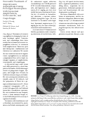 Cover page: Successful Treatment of Angioinvasive Aspergillosis During Prolonged Neutropenia with Liposomal Amphotericin, Voriconazole, and Caspofungin