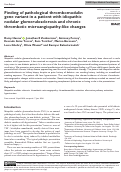 Cover page: Finding of pathological thrombomodulin gene variant in a patient with idiopathic nodular glomerulosclerosis and chronic thrombotic microangiopathy-like changes