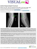 Cover page: Lateral Epicondyle Fracture