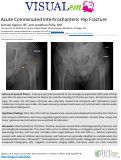 Cover page: Acute Comminuted Intertrochanteric Hip Fracture