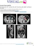 Cover page: Acute Pancreatitis