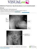 Cover page: Bilateral Posterior Hip Dislocation in an Unrestrained Driver