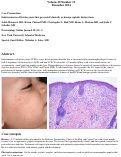 Cover page: Indeterminate cell histiocytosis that presented clinically as benign cephalic histiocytosis