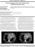 Cover page: Post Transapical Aortic Valve Replacement (TAVR) Pseudoaneurysm