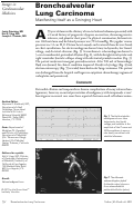 Cover page: Bronchoalveolar lung carcinoma manifesting itself as a swinging heart.
