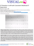 Cover page: ST Elevation in aVR with Coexistent Multilead ST Depression