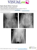 Cover page: Open Book Pelvic Fracture