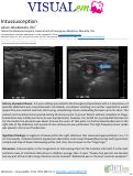 Cover page: Intussusception