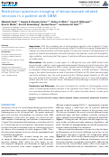 Cover page: Restriction-Spectrum Imaging of Bevacizumab-Related Necrosis in a Patient with GBM