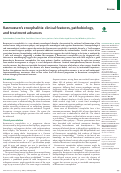 Cover page: Rasmussen's encephalitis: clinical features, pathobiology, and treatment advances