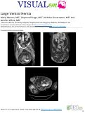 Cover page: Large Ventral Hernia