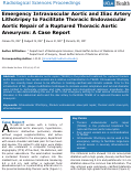 Cover page: Emergency Intravascular Aortic and Iliac Artery Lithotripsy to Facilitate Thoracic Endovascular Aortic Repair of a Ruptured Thoracic Aortic Aneurysm: A Case Report