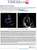 Cover page: Right Atrial Thrombus