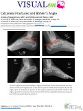 Cover page: Calcaneal Fractures and Böhler’s Angle