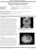 Cover page: Spontaneous Hemoperitoneum from  Rupture of Massive Leiomyoma