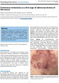 Cover page: Cutaneous metastasis as a first sign of adenocarcinoma of the cervix