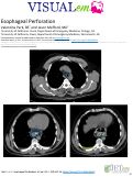 Cover page: Esophageal Perforation