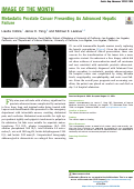 Cover page: Metastatic Prostate Cancer Presenting As Advanced Hepatic Failure