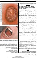 Cover page: Risk of the hemolytic-uremic syndrome after antibiotic treatment of Escherichia coli O157:H7 infections