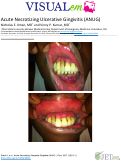 Cover page: Acute Necrotizing Ulcerative Gingivitis (ANUG)