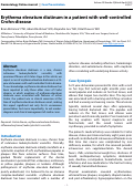 Cover page: Erythema elevatum diutinum in a patient with well-controlled Crohn disease