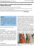 Cover page: Chronic ulcer in a patient with essential thrombocythemia taking hydroxyurea