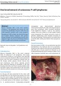 Cover page: Oral involvement of cutaneous T-cell lymphoma