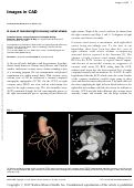 Cover page: A case of isolated right coronary ostial atresia.