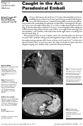 Cover page: Caught in the Act: Paradoxical Emboli