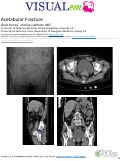 Cover page: Acetabular Fracture